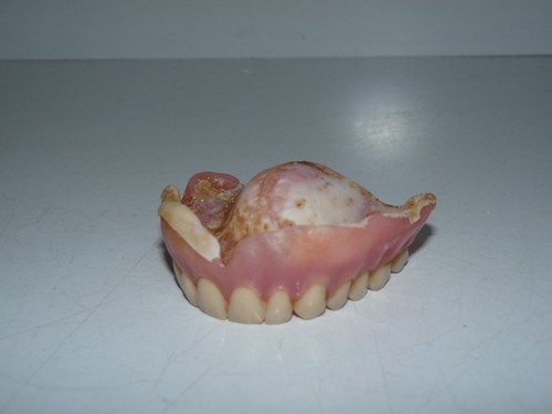 Ancien dentier prothèse