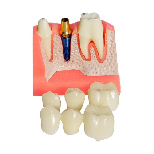 Modèle implant dentaire - d'implant,