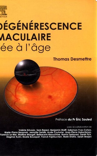 Dégénérescence maculaire