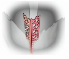 18 mètres de cornières en