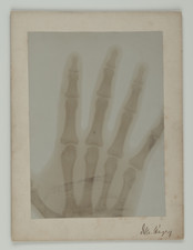 Radiographie d'une main
