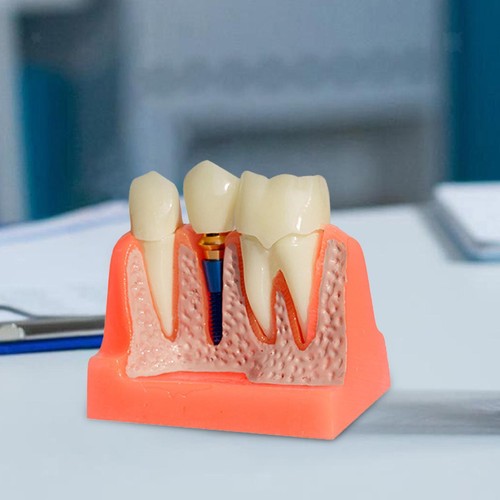 Modèle implant dentaire 4 - d'implant,