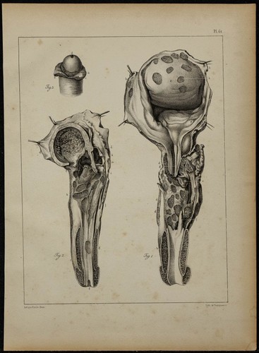 1839 planche urologie - 1839,