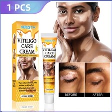 Vitiligo Sweat Spot Piebald Crème Improve Skin Pigmentation Reduces White Spots