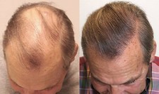 Minoxidil 2% Extra Fort 1 Mois