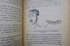 Prothèse restauratrice