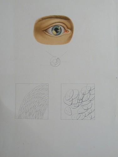 Epithélioma perlé iris - de, l'iris