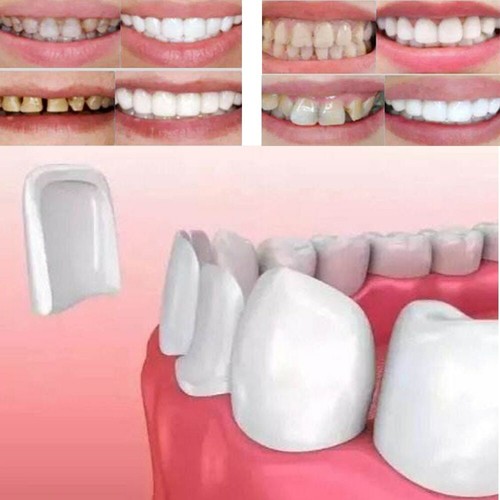 Couvre dents sourire - couvre, facettes