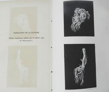 RARE : DE LA BRONCHITE PSEUDO-MEMBRANEUSE CHRONIQUE - P. LUCAS-CHAMPIONNIERE EO