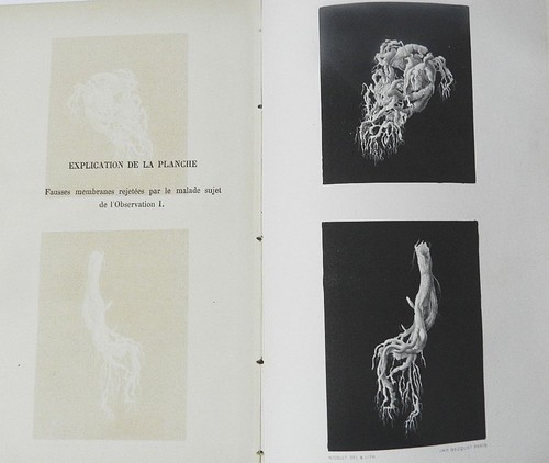 Rare la bronchite - la,