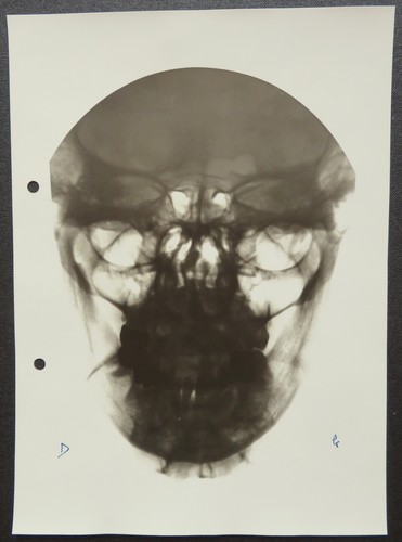 Radiographie ray radiograph - radiographie,