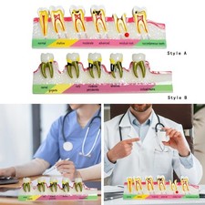 Modèle dentaire prothèse