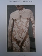 Gravure médecine couleur 1900 maladie de la peau : VITILIGO