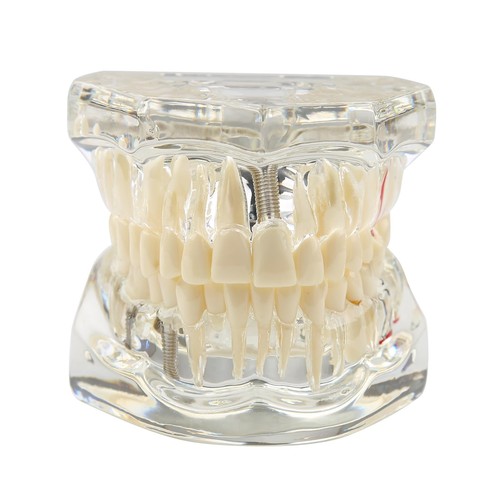 Modèle dentaire transparent