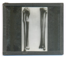 Plaque LOURDES Guérisons miraculeuses -Os de De Rudder- Projection type MOLTENI