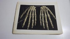 1850.lithographie couleur main squelette (106) anatomie medecine..z