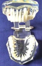 Modèle d'étude d'implant