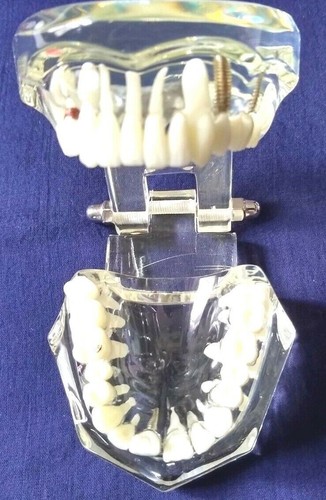 Modèle étude implant - modèle, d'étude