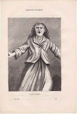Ancienne gravure médicale 83 - Médecine pratique - Attaque de catalepsie