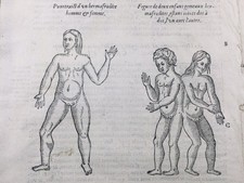 Hermaphrodite 1614 Gémellité Androgyne Transsexuel Saint Auban Cocquin Jumeau