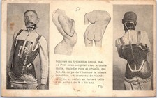 MEDECINE - corset pour scoliose au 3eme degree