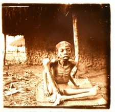 Stereoscopic Glass View, 45x107mm, Enfant émacié / Starving child, Jules Richard