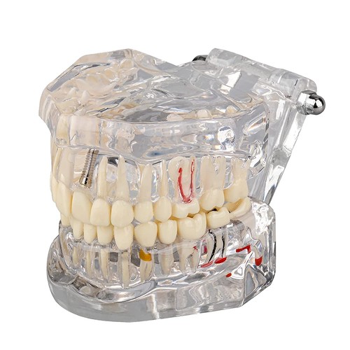 Modèle dents de maladie - de,
