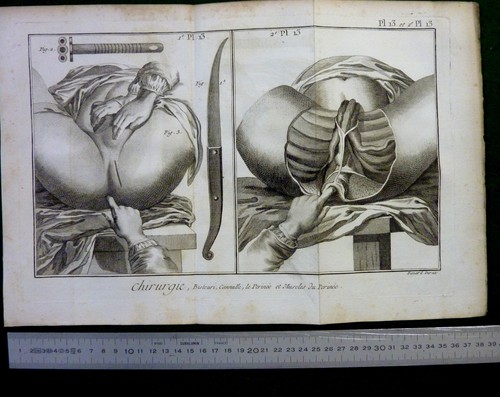 1779 double planche chirurgie - 1779,