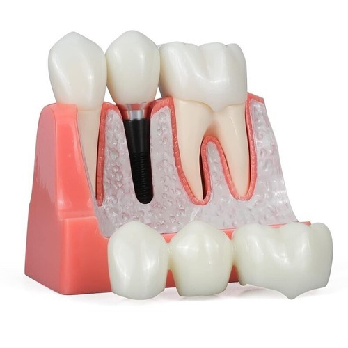 Modèle implant dentaire - d’implant,