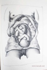 MOREAU, François-Joseph Traité pratique des accouchemens.