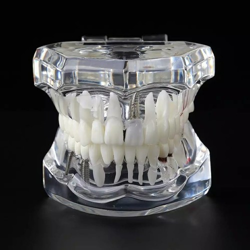 Modèle implant dentaire - d'implant,