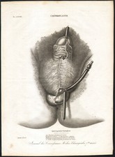 1835 Gravure Anatomie Urétroplastie Chirurgie Urètre Vessie Pénis Médecine