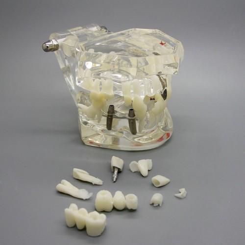 étude implant dentaire - Étude,