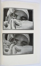 ophtalmologie. R. de SAINT-MARTIN. L'extraction totale de la cataracte.
