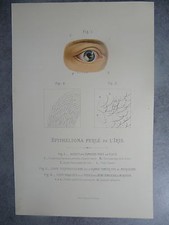 Epithélioma perlé de l'iris  lithographie Monoyer ophtalmologie optique médecine