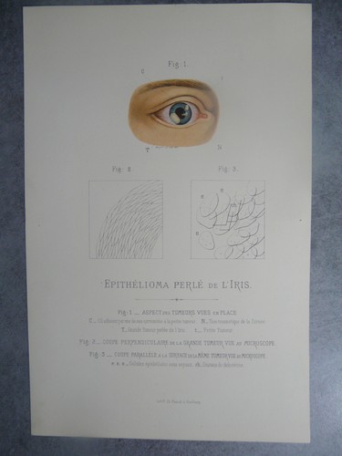 Epithélioma perlé iris - epithélioma, l'iris