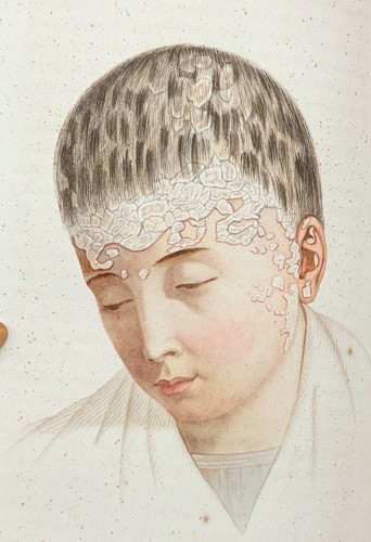 Cazenave traité des maladies - traitÉ,