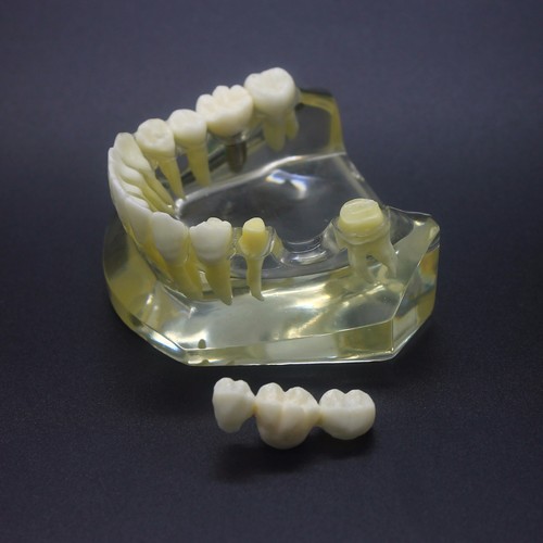 étude implant dentaire - d'implant,