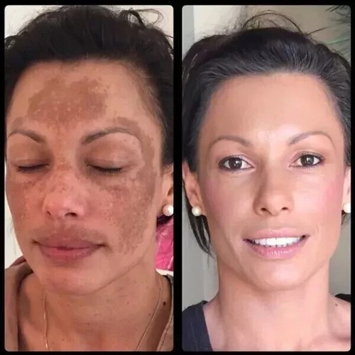 Gel mederma advanced plus - advanced, scar