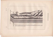 Ancienne gravure médicale 38- Médecine pratique - Appareil hyponarthécique