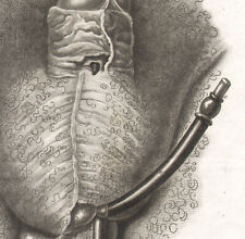 1835 Gravure Anatomie Urétroplastie Chirurgie Urètre Vessie Pénis Médecine