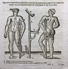 Prothèse d’Ambroise Paré 1614 Chirurgie Orthopédique Médecine Appareillage