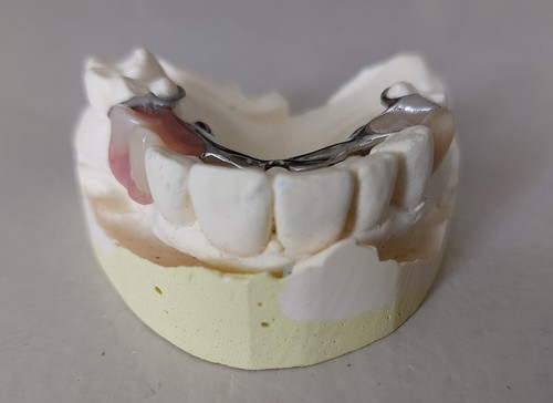 Dentier moulage plâtre - dentier,