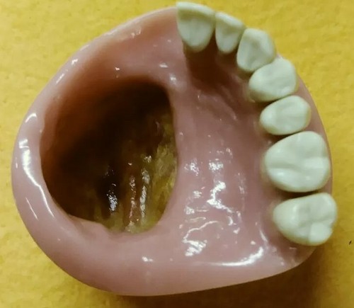 Cleft palate dental - cleft,